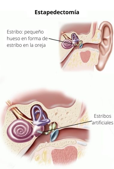 Stapedectomy: Definition, Surgery, Procedure & Recovery