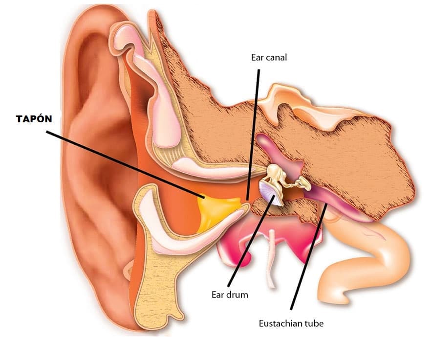 Arena Toro Deliberar Cómo quitar el tapón de mi oído | Claso Audiología®